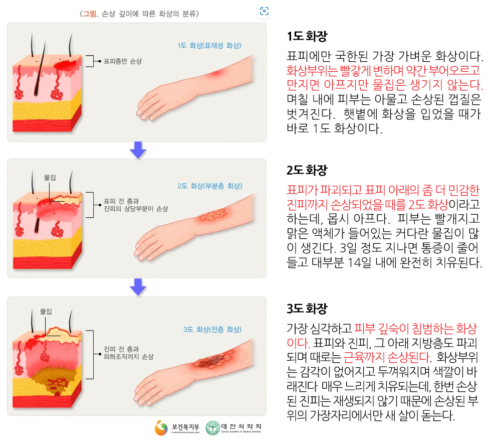 응급대처 요양보호-화상